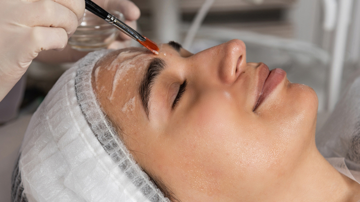 Carbon-Facial-in-Noida